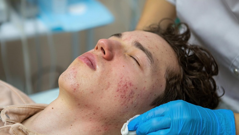 درمان خانگی جوش هورمونی