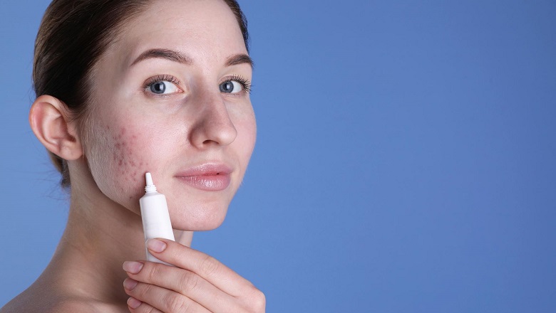 درمان جوش های هورمونی