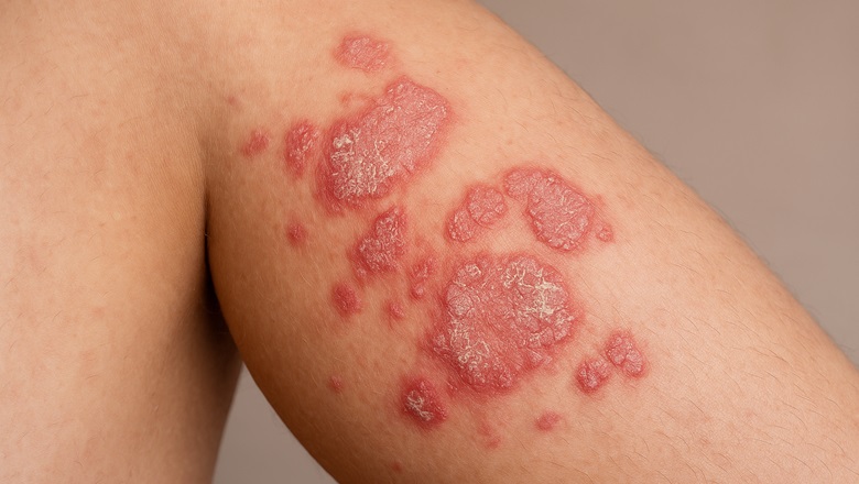 پسوریازیس و اگزما از علائم جوش کبدی